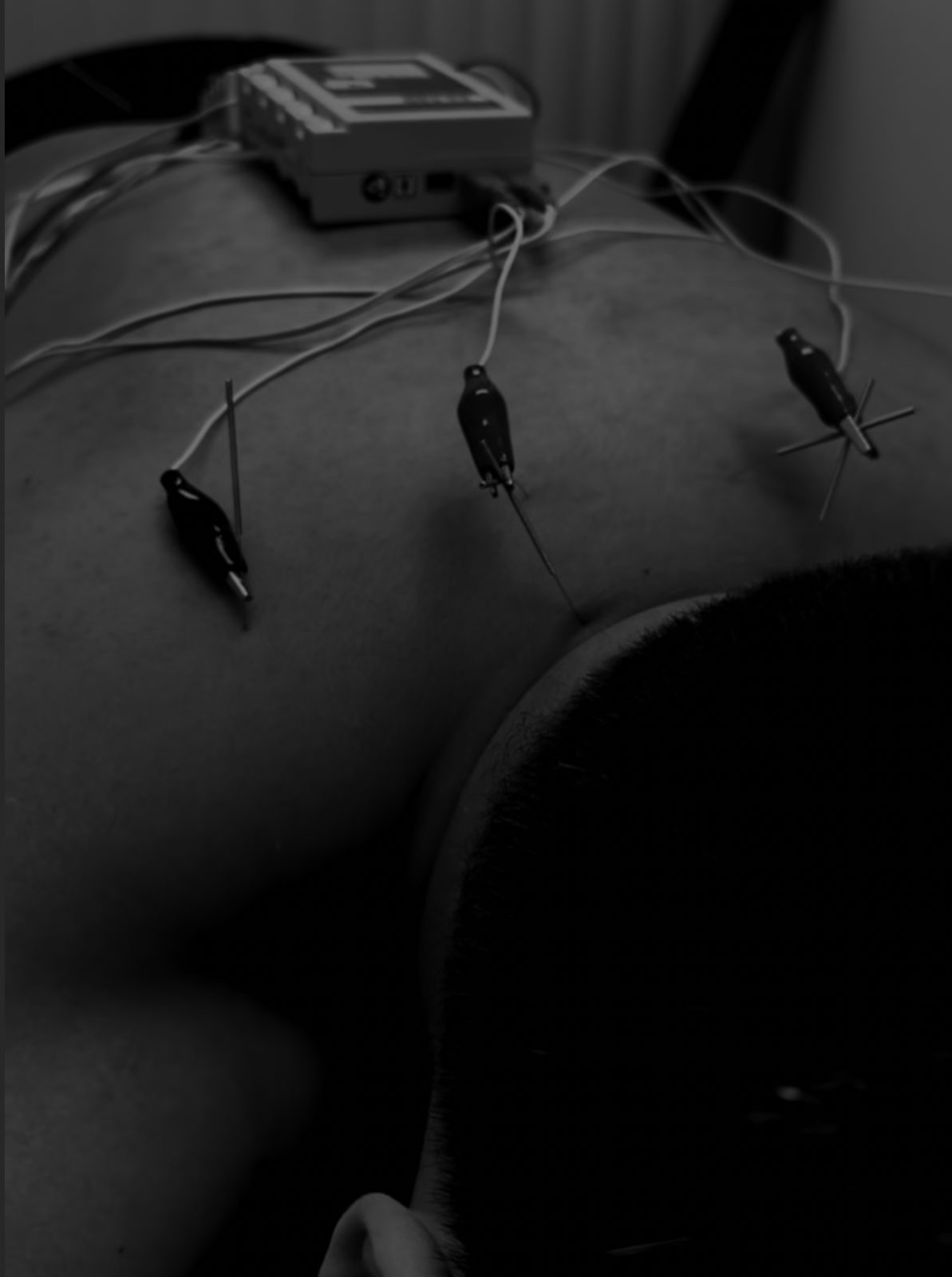 Acupuncture treatment at Performance Recovery Therapy in Toronto